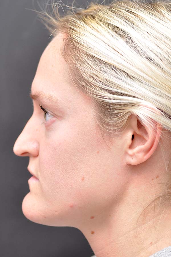 Chin Reduction Before and After | Northside Plastic Surgery