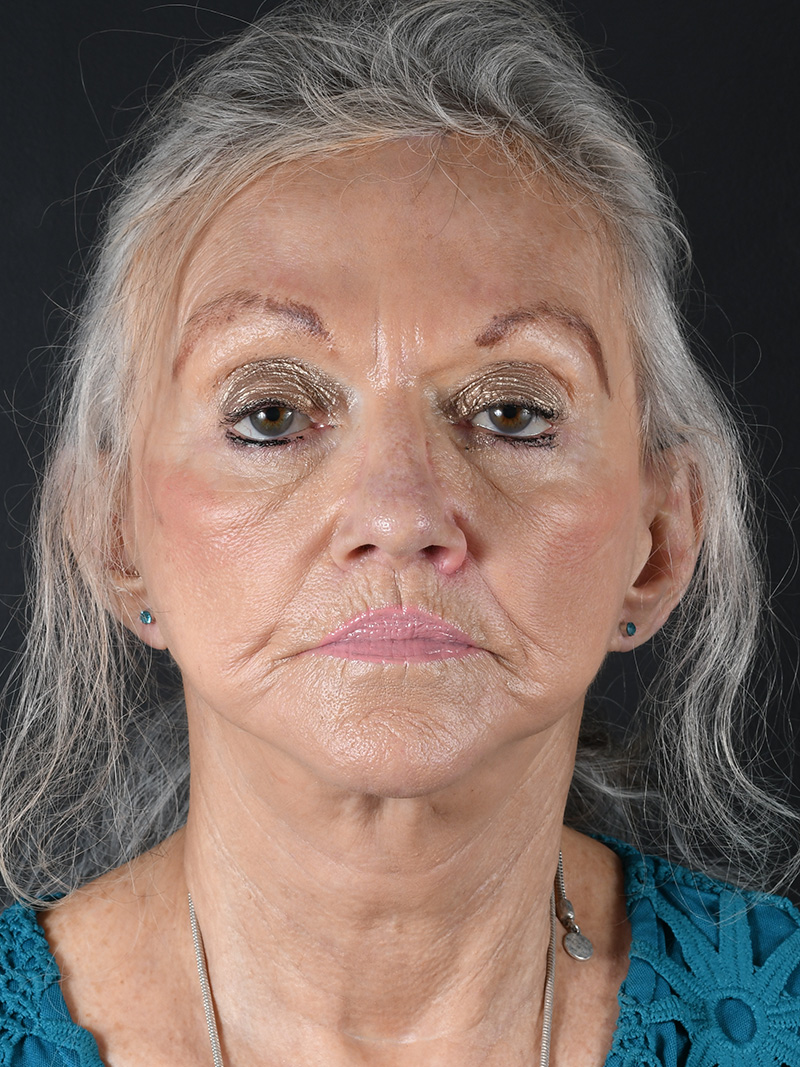 Co2 Laser Before and After | Northside Plastic Surgery