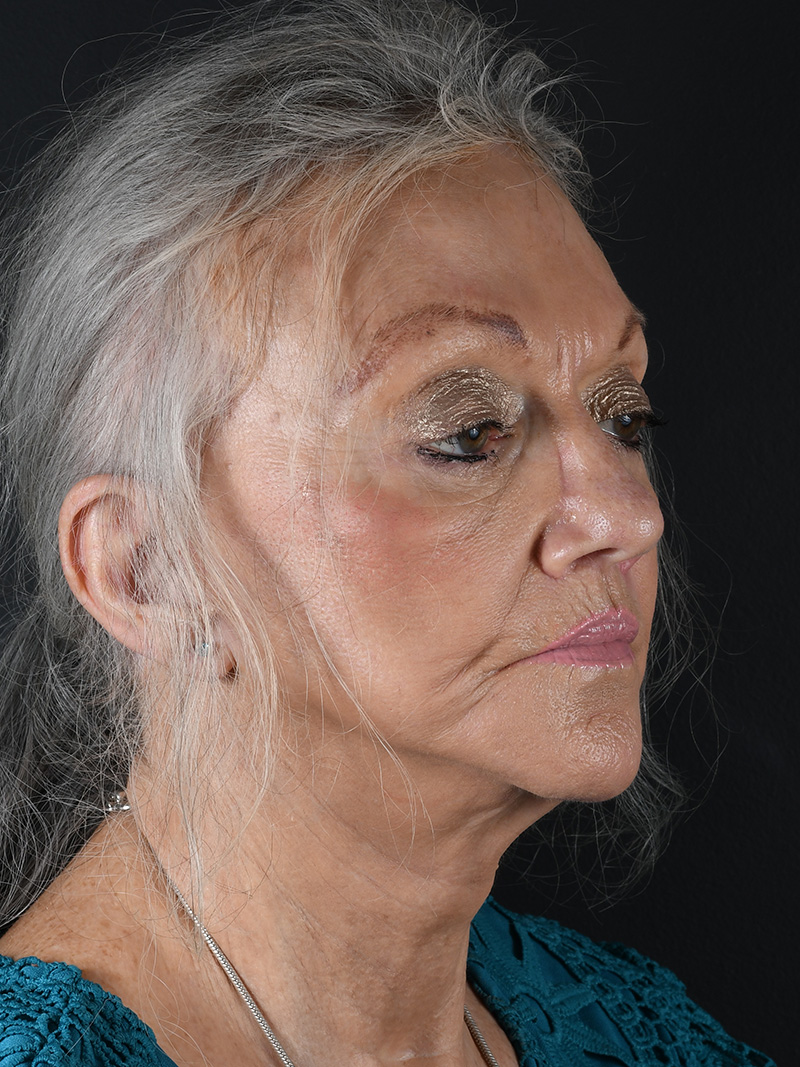 Co2 Laser Before and After | Northside Plastic Surgery