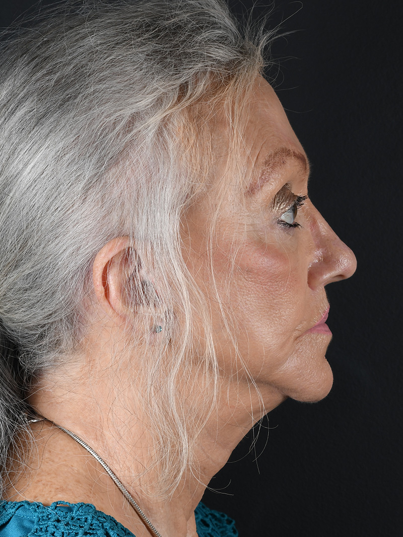 Co2 Laser Before and After | Northside Plastic Surgery