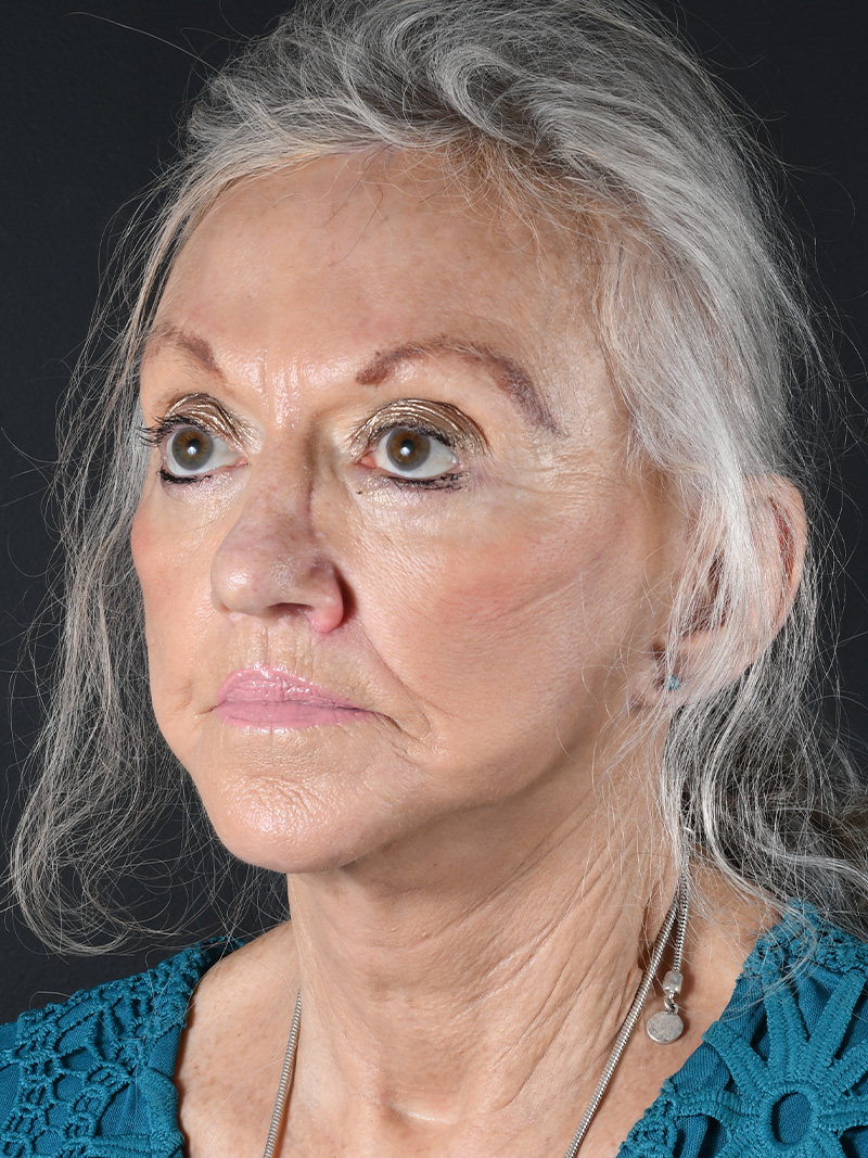 Co2 Laser Before and After | Northside Plastic Surgery