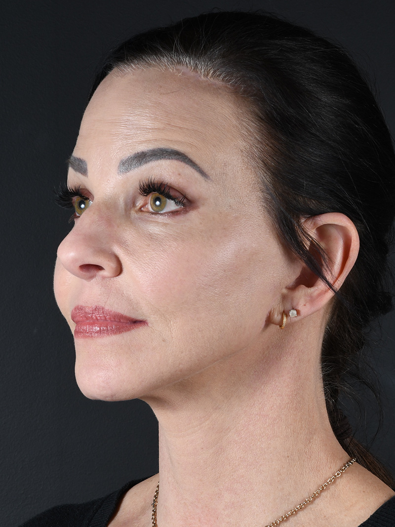Co2 Laser Before and After | Northside Plastic Surgery