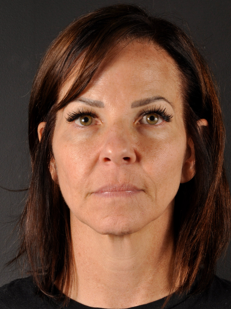 Co2 Laser Before and After | Northside Plastic Surgery