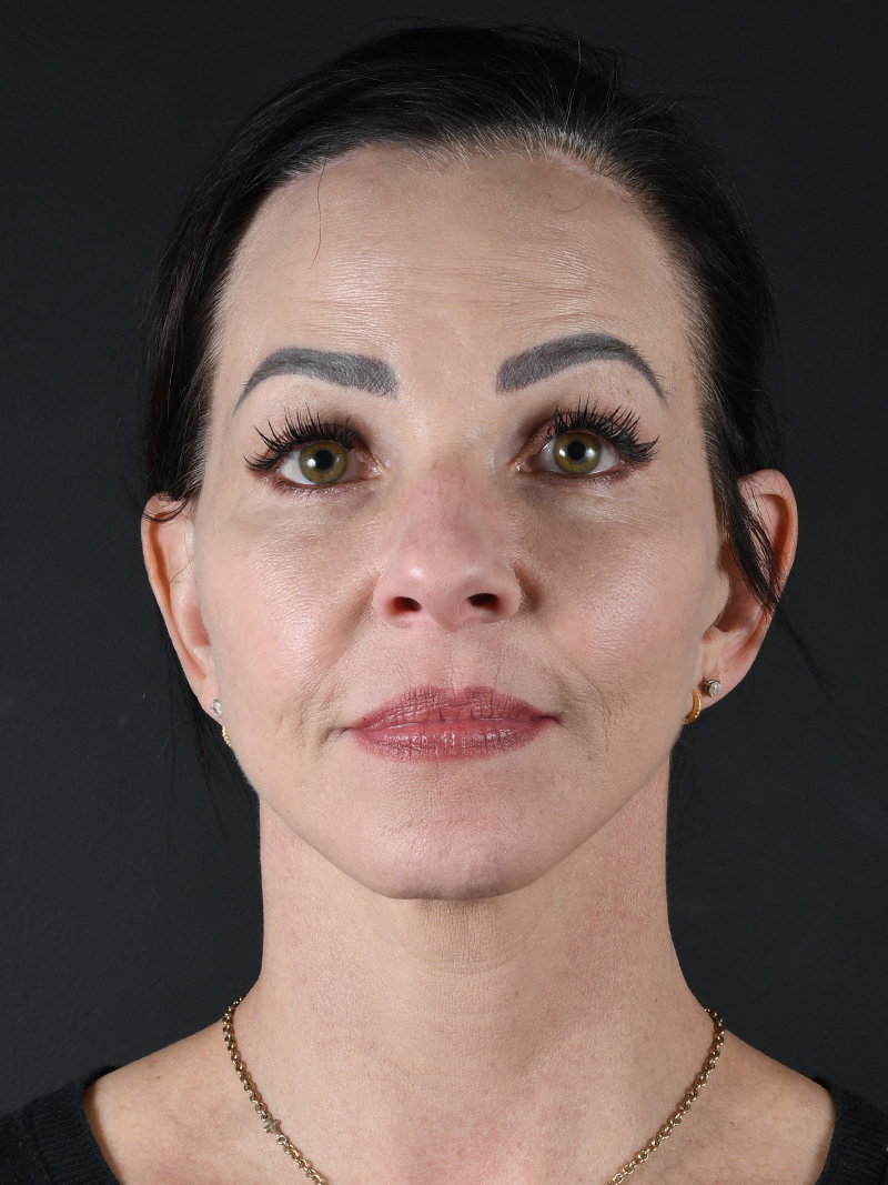 Co2 Laser Before and After | Northside Plastic Surgery