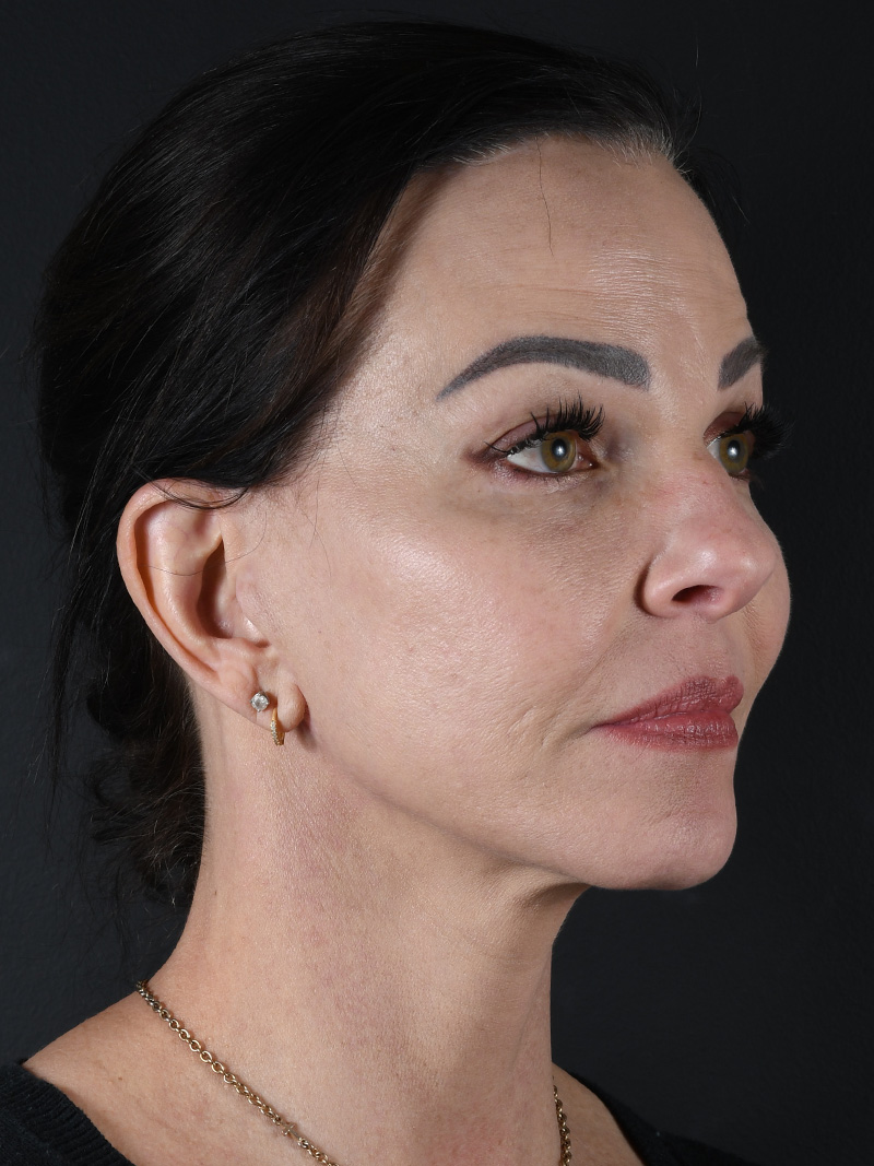 Co2 Laser Before and After | Northside Plastic Surgery