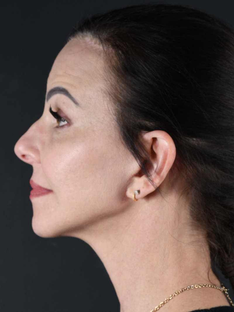 Co2 Laser Before and After | Northside Plastic Surgery