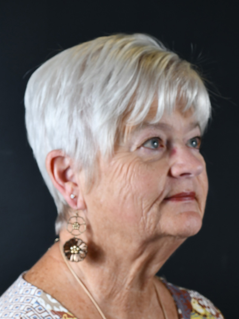 Co2 Laser Before and After | Northside Plastic Surgery