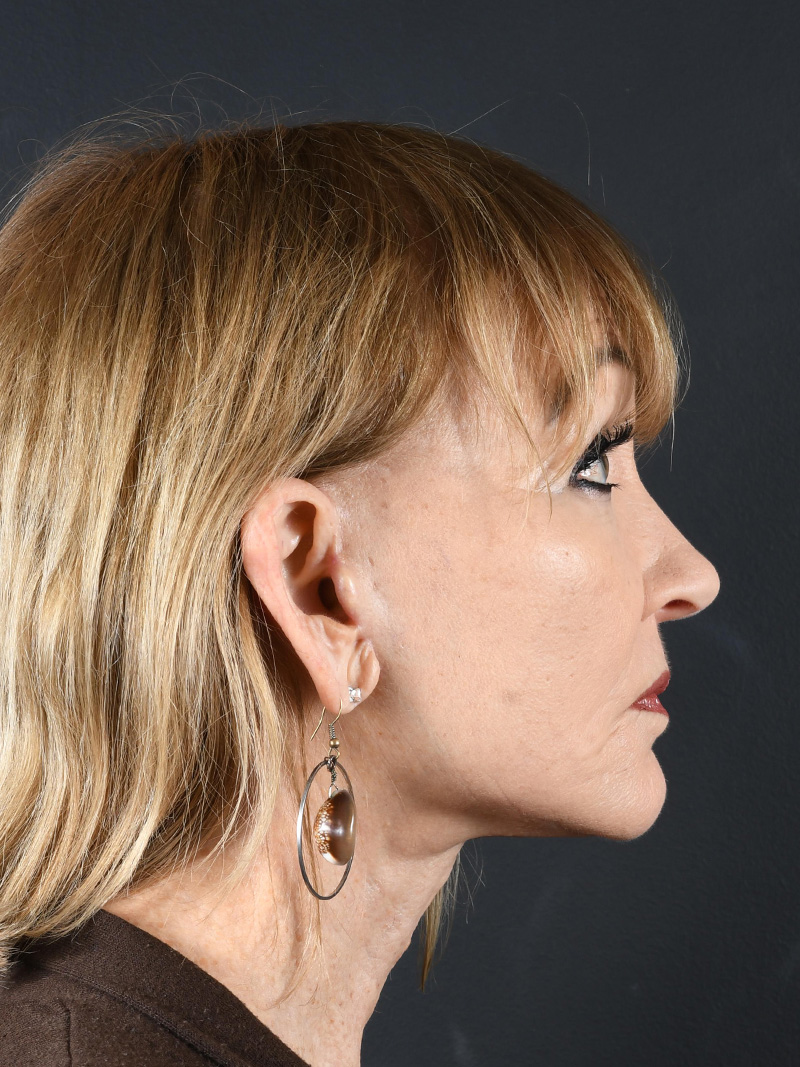 Co2 Laser Before and After | Northside Plastic Surgery