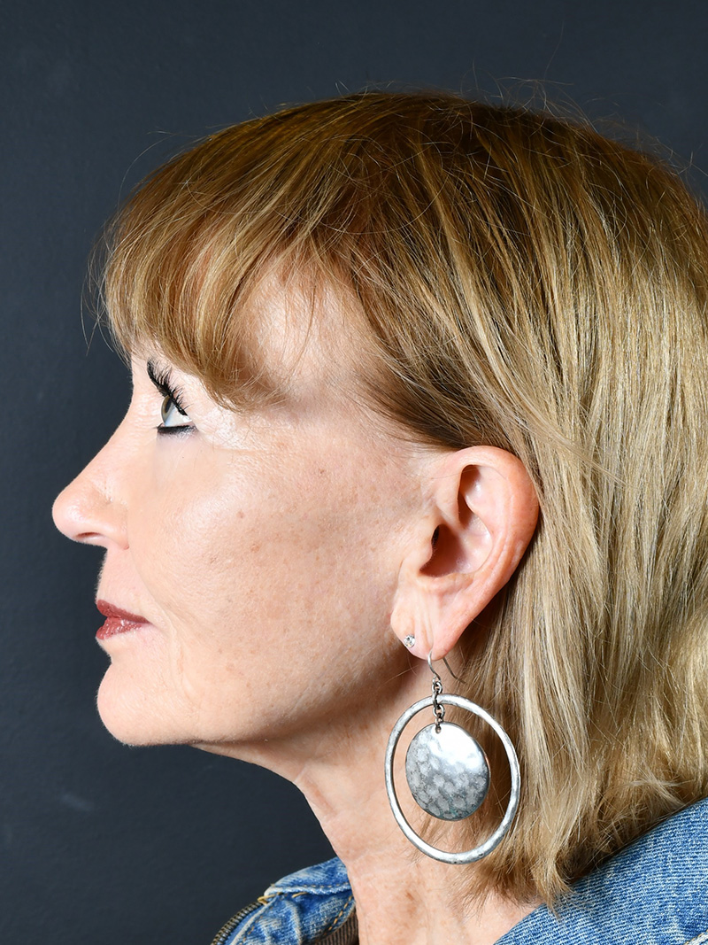 Co2 Laser Before and After | Northside Plastic Surgery