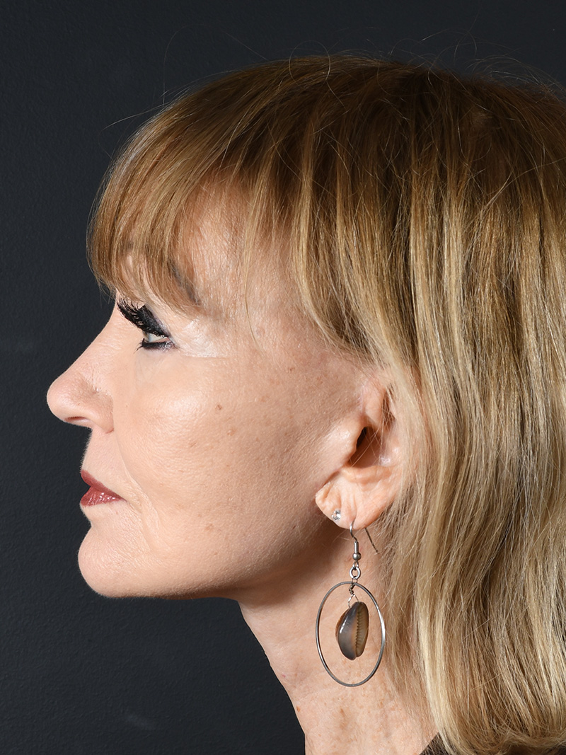 Co2 Laser Before and After | Northside Plastic Surgery