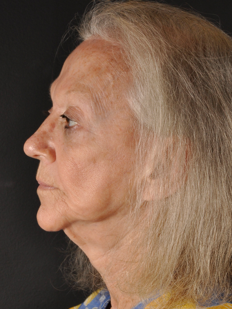 Co2 Laser Before and After | Northside Plastic Surgery