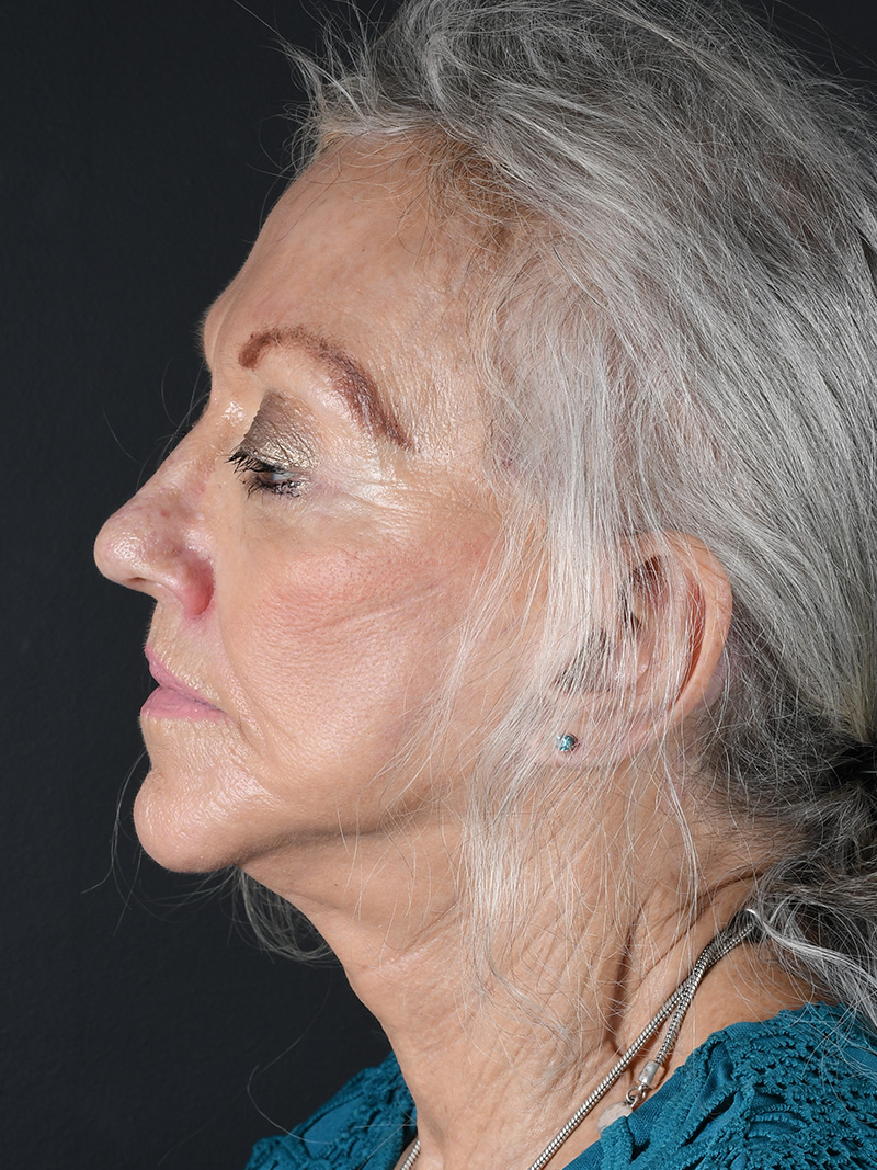 Co2 Laser Before and After | Northside Plastic Surgery
