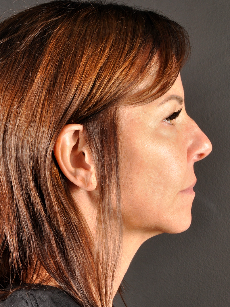 Co2 Laser Before and After | Northside Plastic Surgery