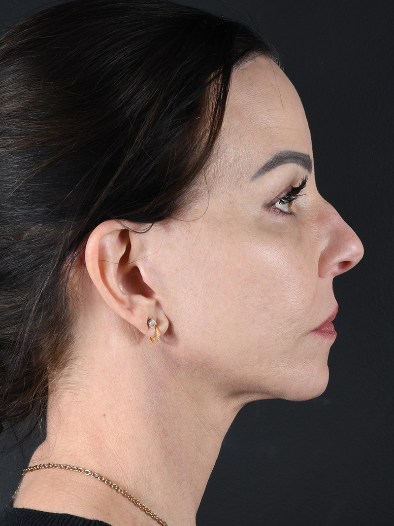 Co2 Laser Before and After | Northside Plastic Surgery