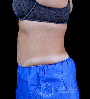 Coolsculpting Before and After | Northside Plastic Surgery