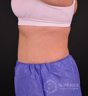 Coolsculpting Before and After | Northside Plastic Surgery