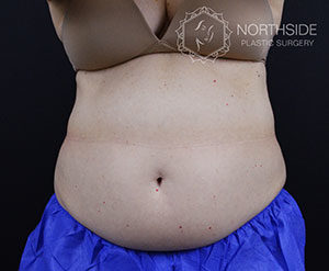 Coolsculpting Before and After | Northside Plastic Surgery