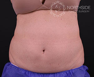 Coolsculpting Before and After | Northside Plastic Surgery