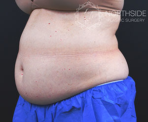 Coolsculpting Before and After | Northside Plastic Surgery