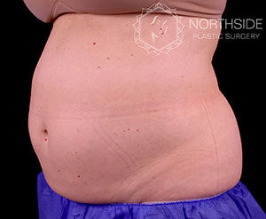 Coolsculpting Before and After | Northside Plastic Surgery