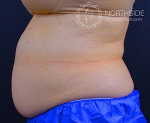 Coolsculpting Before and After | Northside Plastic Surgery