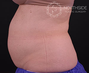 Coolsculpting Before and After | Northside Plastic Surgery