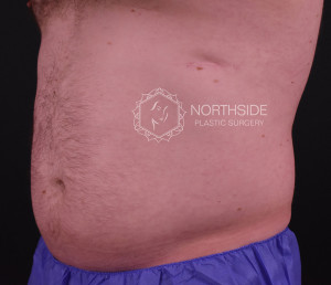 Coolsculpting Before and After | Northside Plastic Surgery