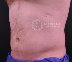 Coolsculpting Before and After | Northside Plastic Surgery