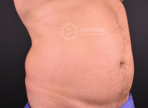 Coolsculpting Before and After | Northside Plastic Surgery