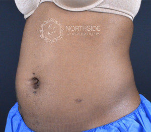 Coolsculpting Before and After | Northside Plastic Surgery