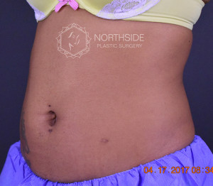 Coolsculpting Before and After | Northside Plastic Surgery