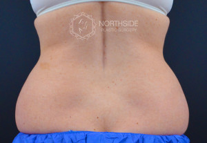 Coolsculpting Before and After | Northside Plastic Surgery