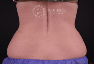 Coolsculpting Before and After | Northside Plastic Surgery