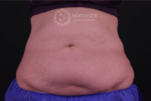 Coolsculpting Before and After | Northside Plastic Surgery