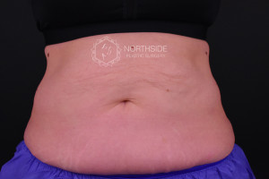 Coolsculpting Before and After | Northside Plastic Surgery