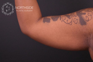 Coolsculpting Before and After | Northside Plastic Surgery