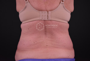 Coolsculpting Before and After | Northside Plastic Surgery