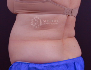 Coolsculpting Before and After | Northside Plastic Surgery