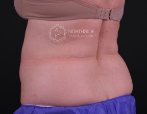 Coolsculpting Before and After | Northside Plastic Surgery