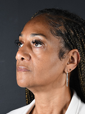 Ethnic Rhinoplasty Before and After | Northside Plastic Surgery