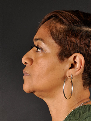 Ethnic Rhinoplasty Before and After | Northside Plastic Surgery