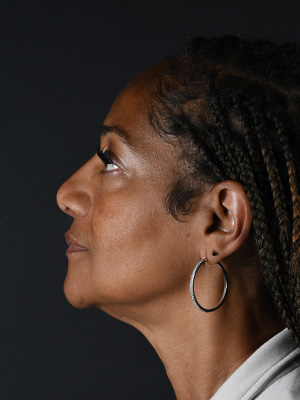 Ethnic Rhinoplasty Before and After | Northside Plastic Surgery