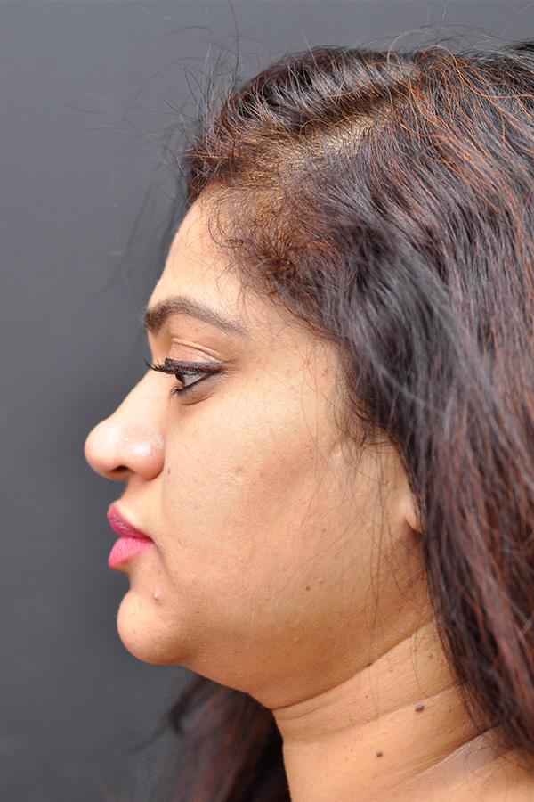 Ethnic Rhinoplasty Before and After | Northside Plastic Surgery