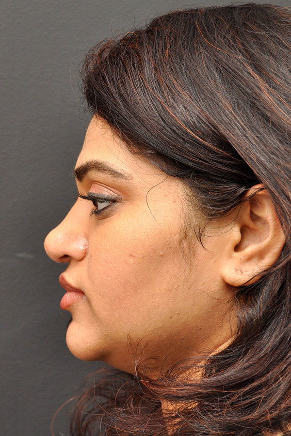 Ethnic Rhinoplasty Before and After | Northside Plastic Surgery