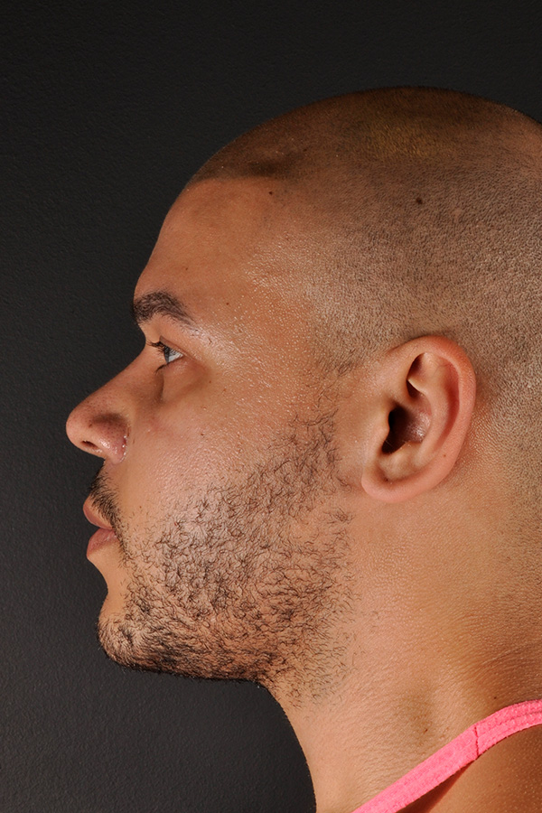 Ethnic Rhinoplasty Before and After | Northside Plastic Surgery