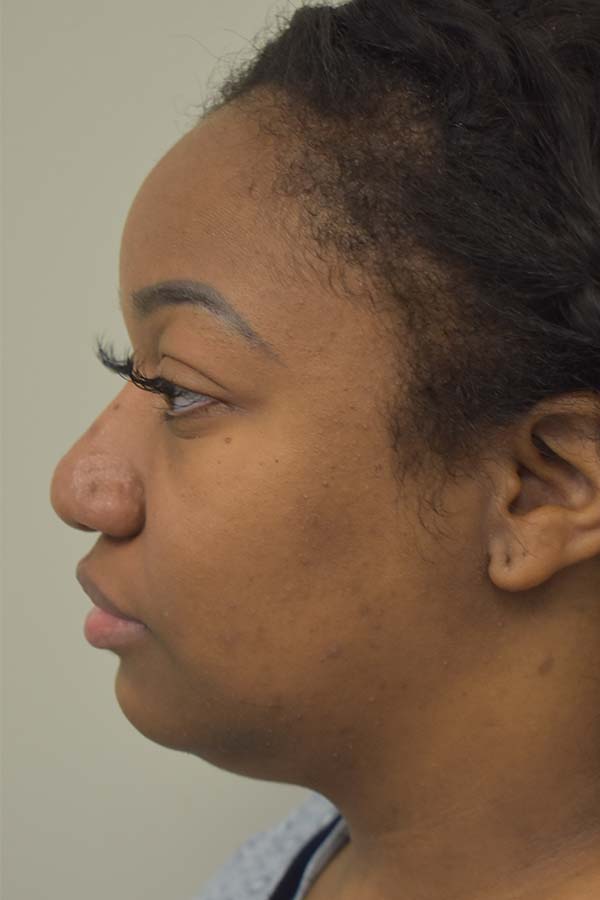 Ethnic Rhinoplasty Before and After | Northside Plastic Surgery