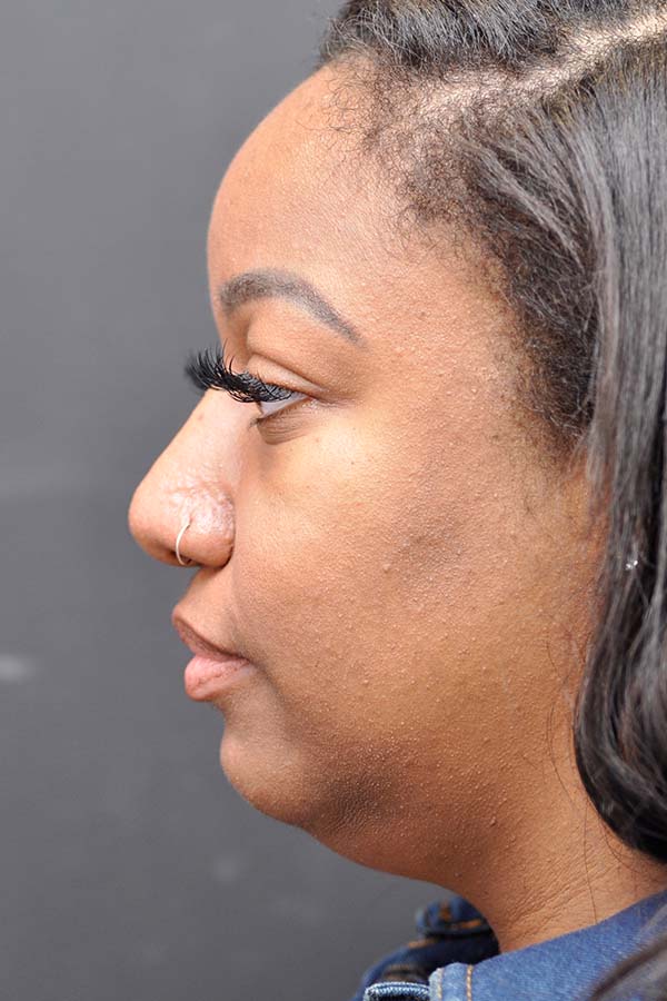 Ethnic Rhinoplasty Before and After | Northside Plastic Surgery