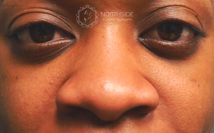 Ethnic Rhinoplasty Before and After | Northside Plastic Surgery