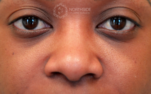 Ethnic Rhinoplasty Before and After | Northside Plastic Surgery