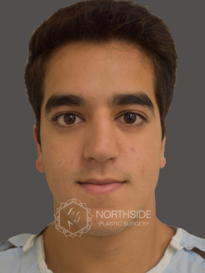 Ethnic Rhinoplasty Before and After | Northside Plastic Surgery